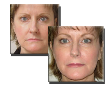 Injections around around eyes, lips and to cheeks.