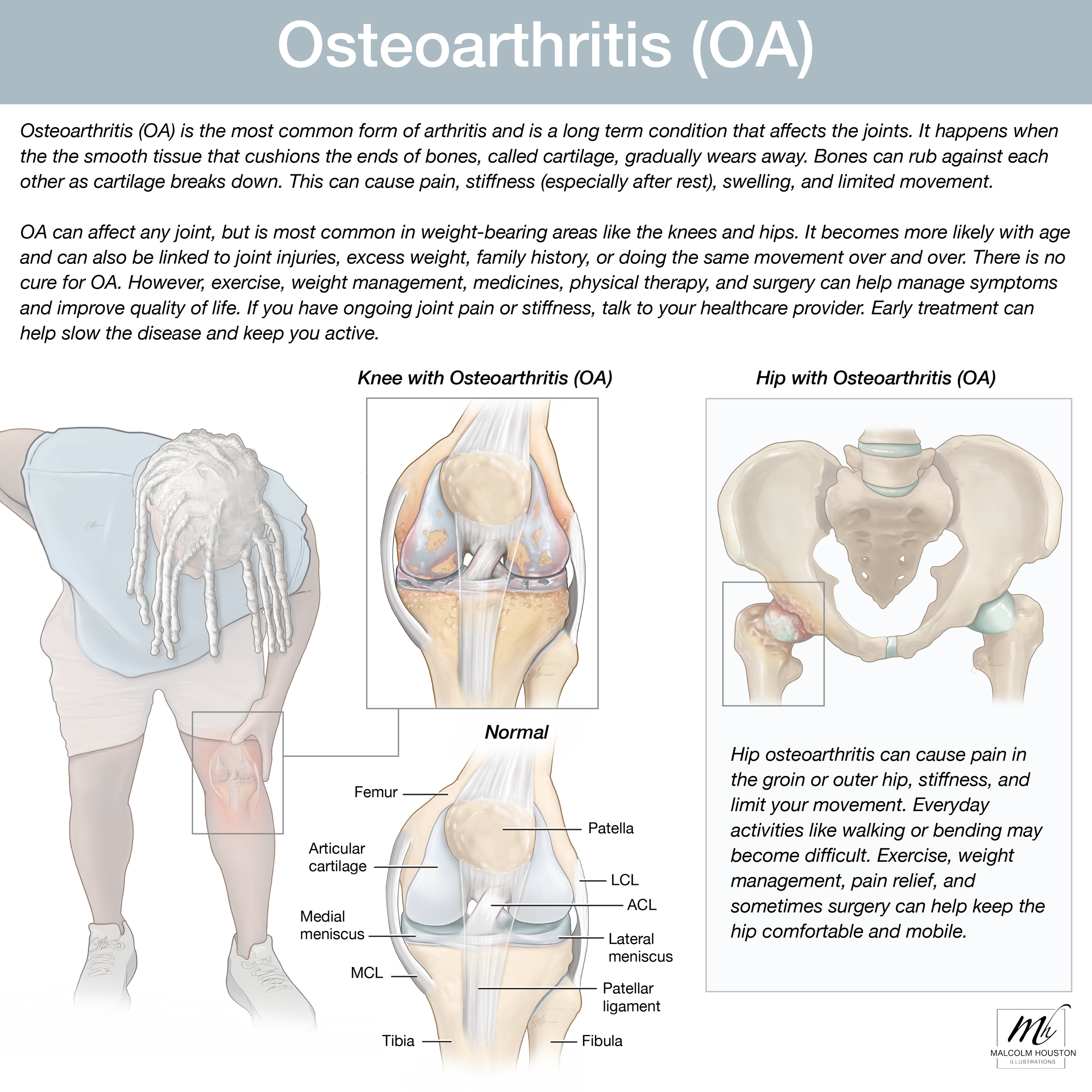 Osteoarthritis