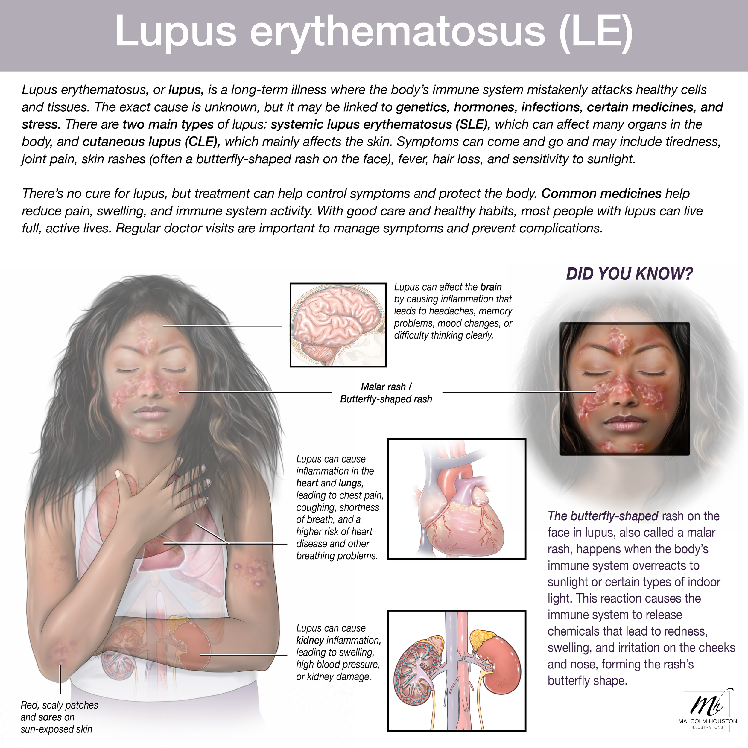 Lupus