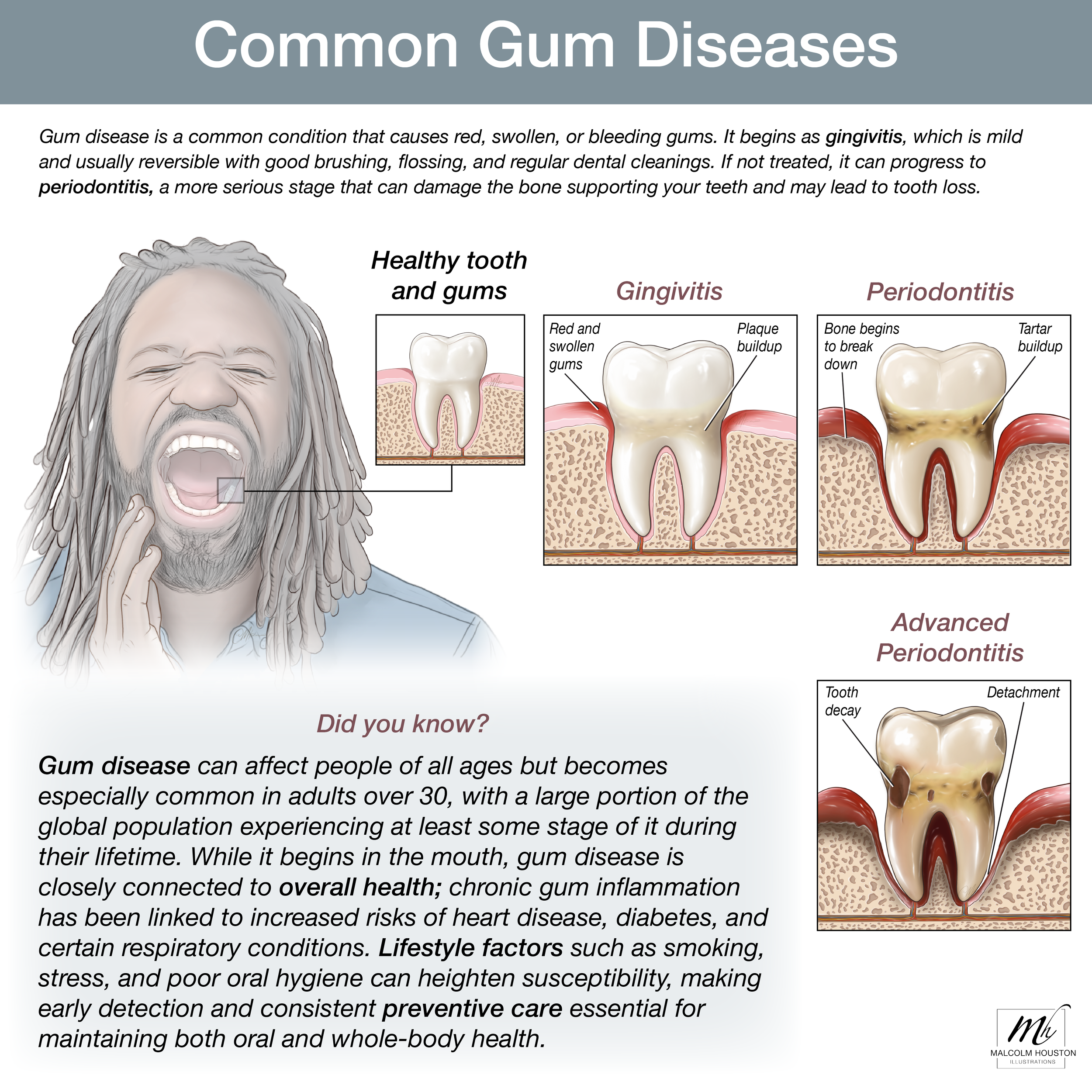 Common Gum Diseases
