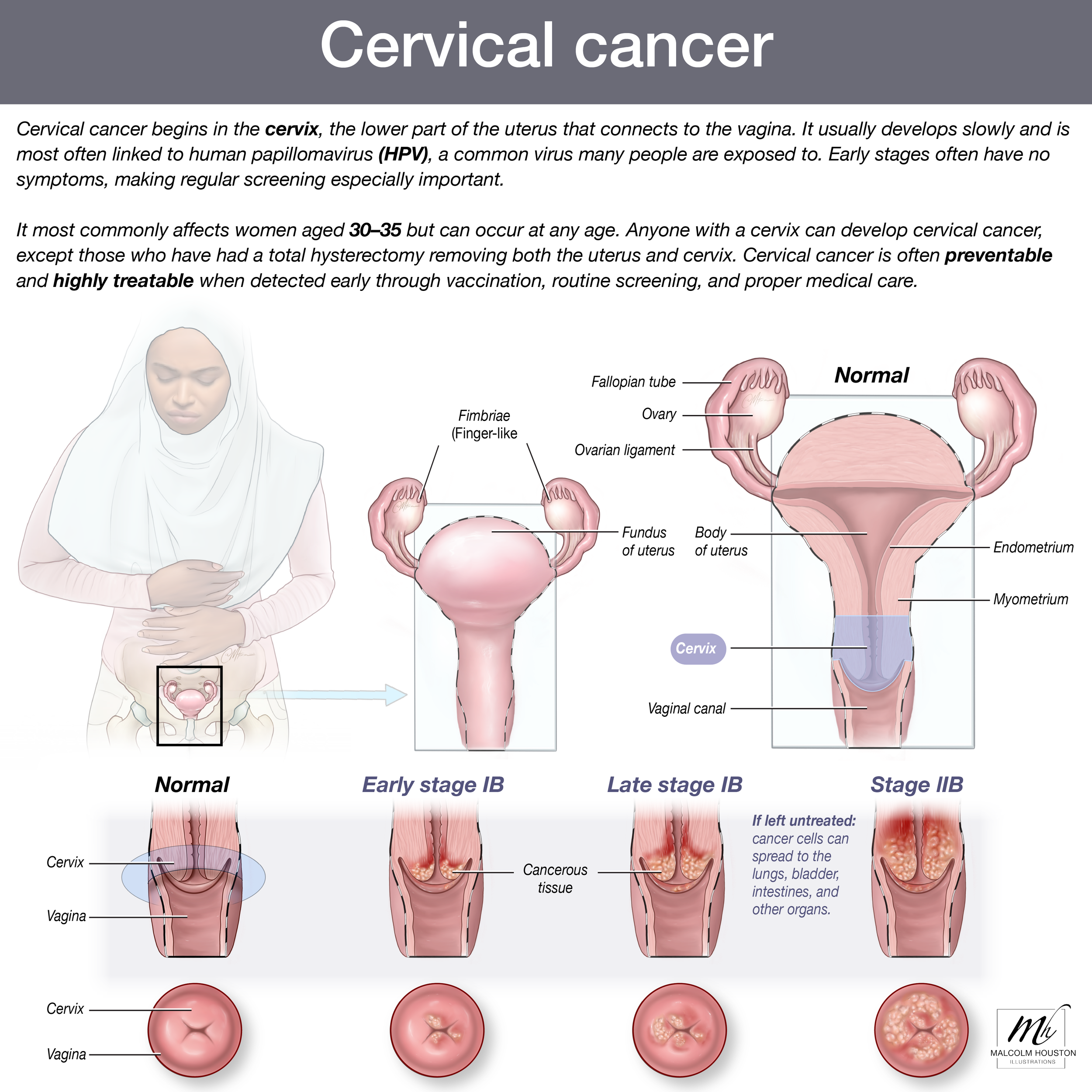 Cervical cancer