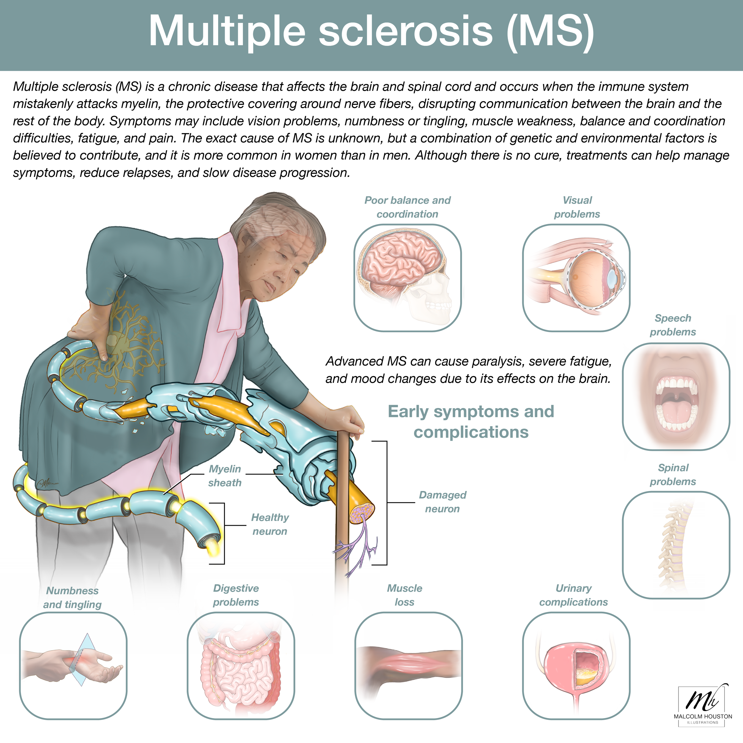 Multiple Sclerosis (MS)
