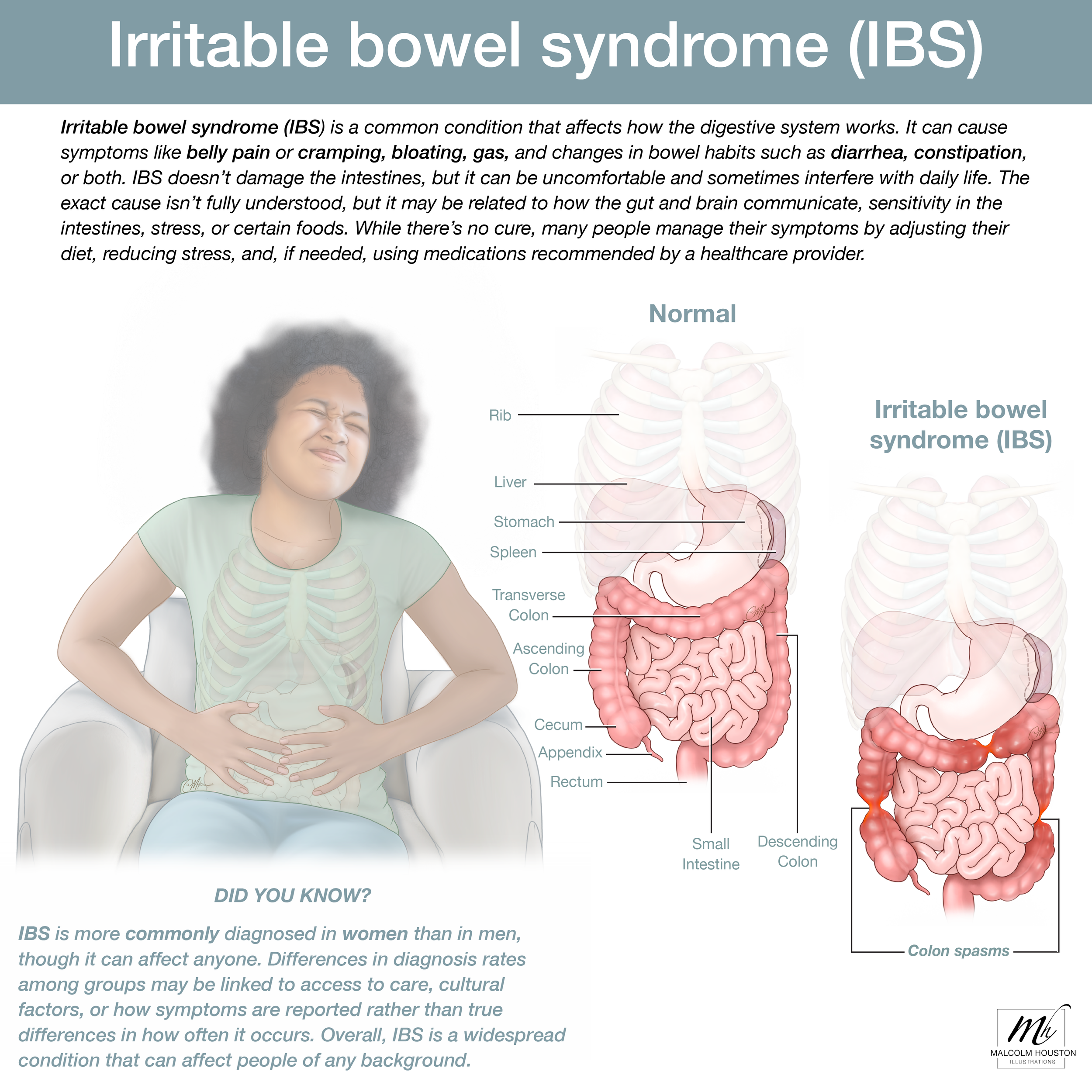 Irritable bowel syndrome (IBS)