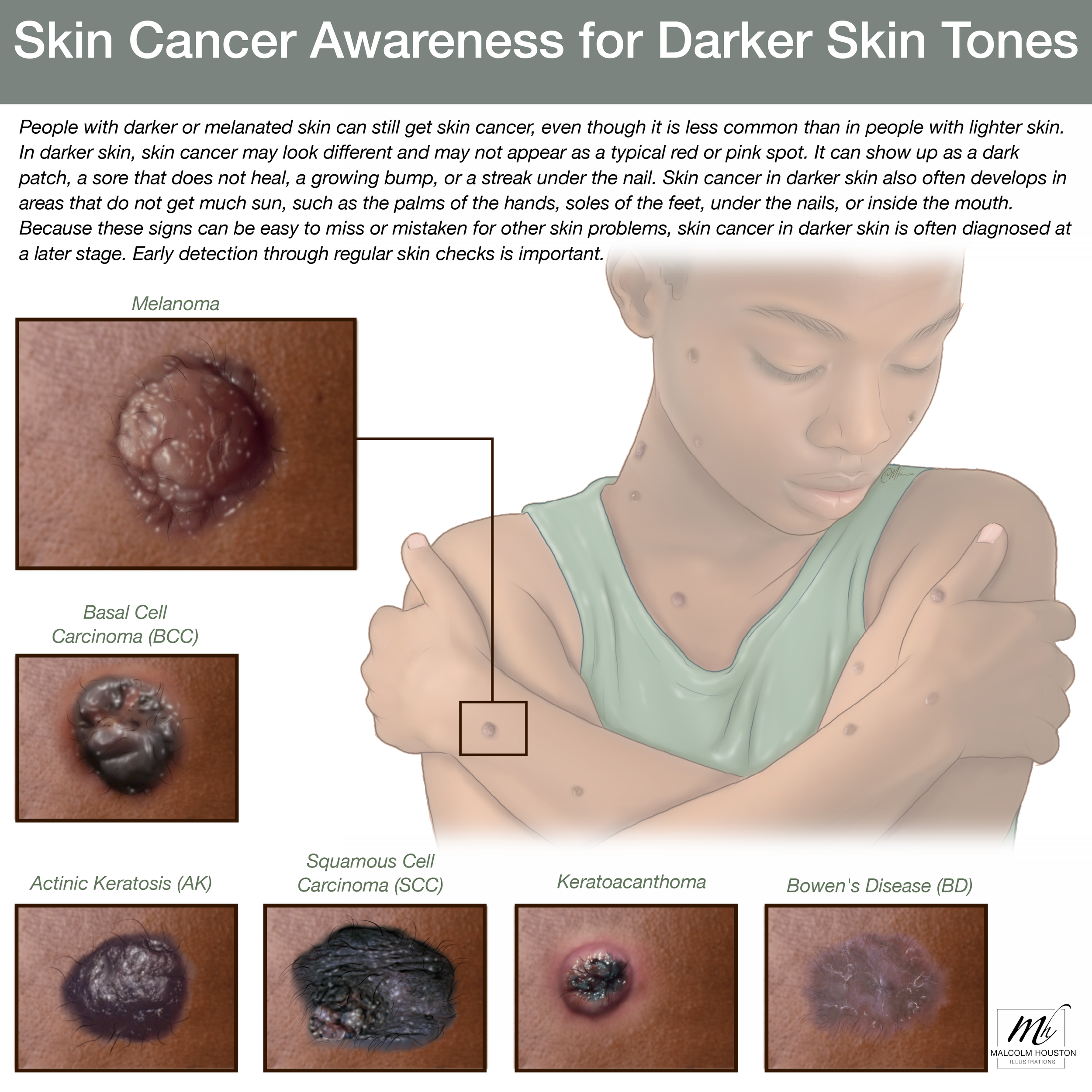 Skin Cancer Awareness for Darker Skin Tones