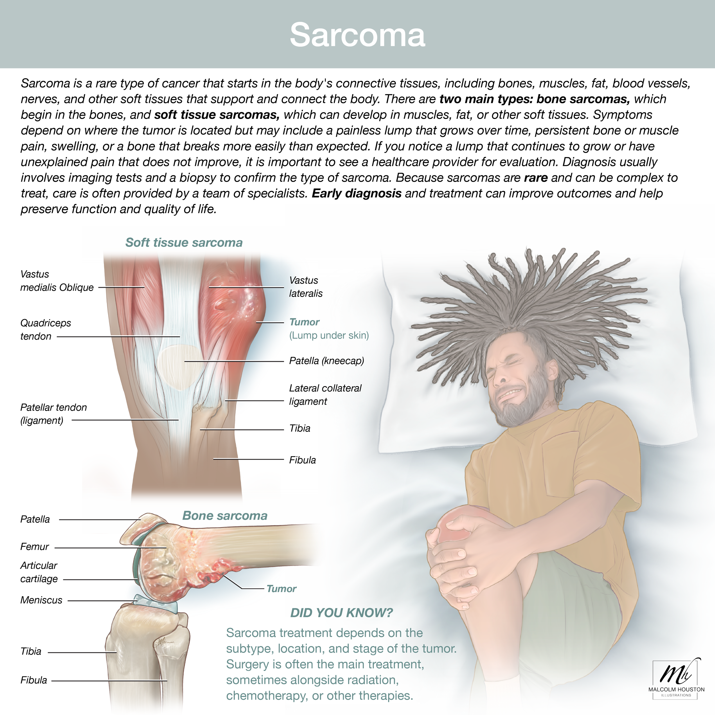 Sarcoma