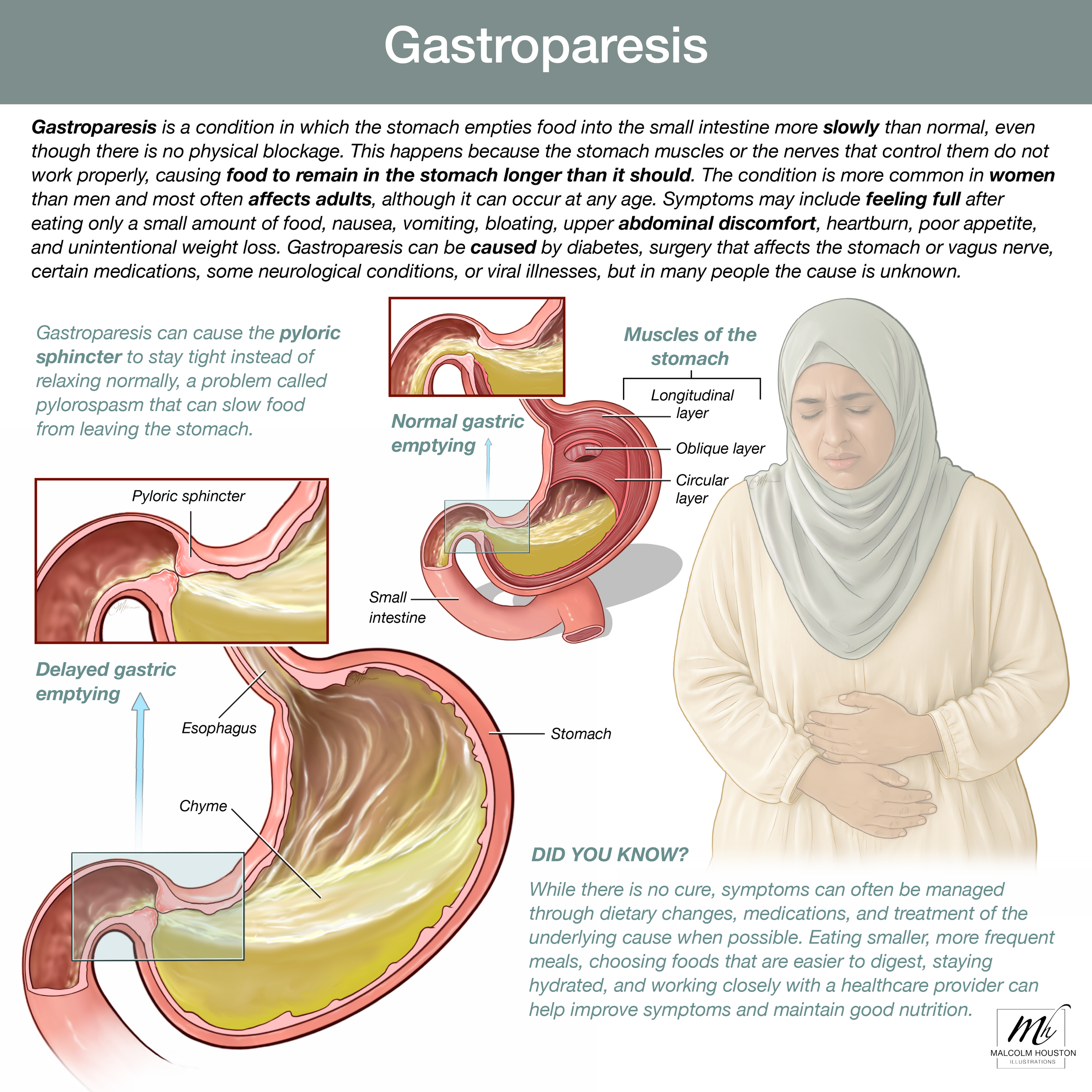 Gastroparesis