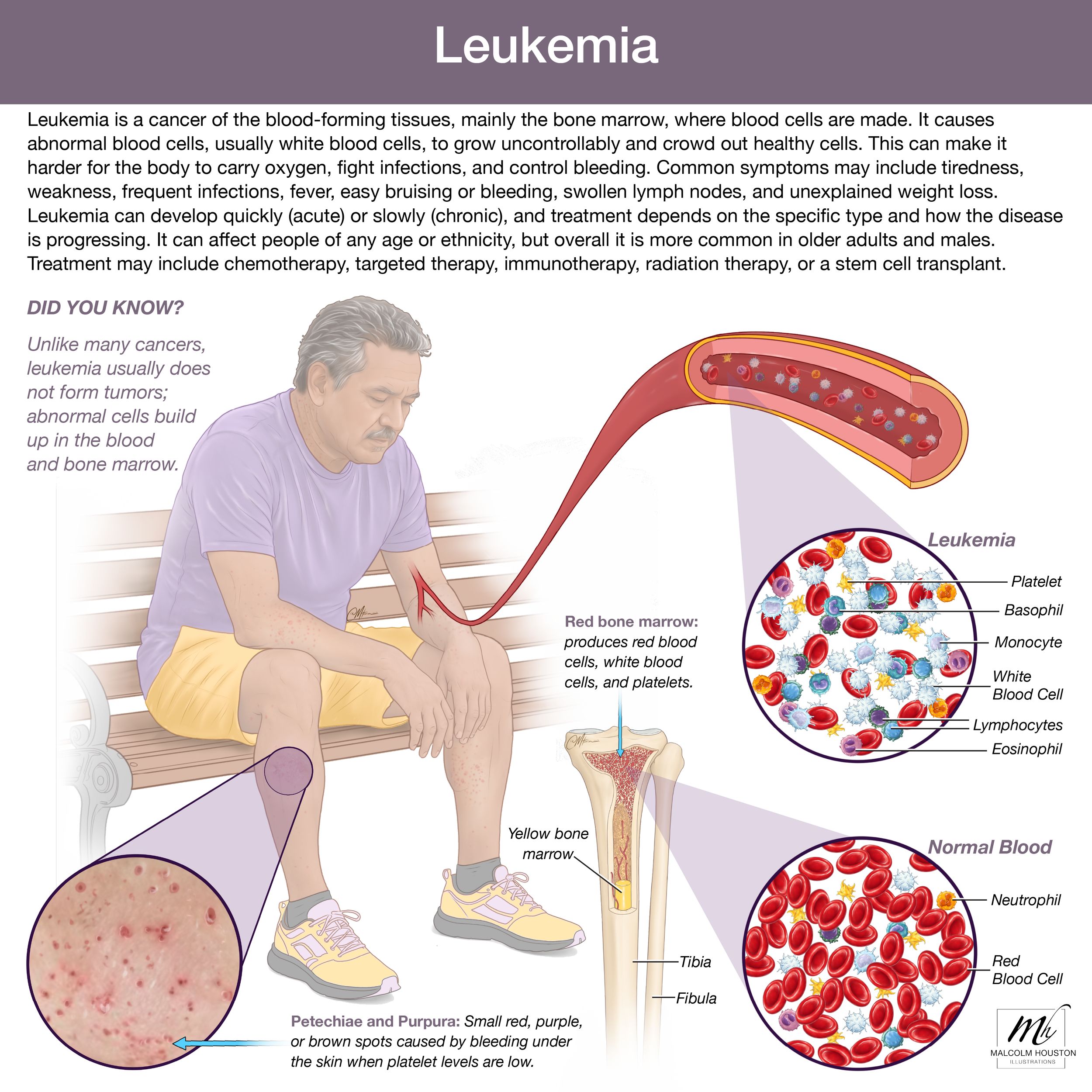 Leukemia