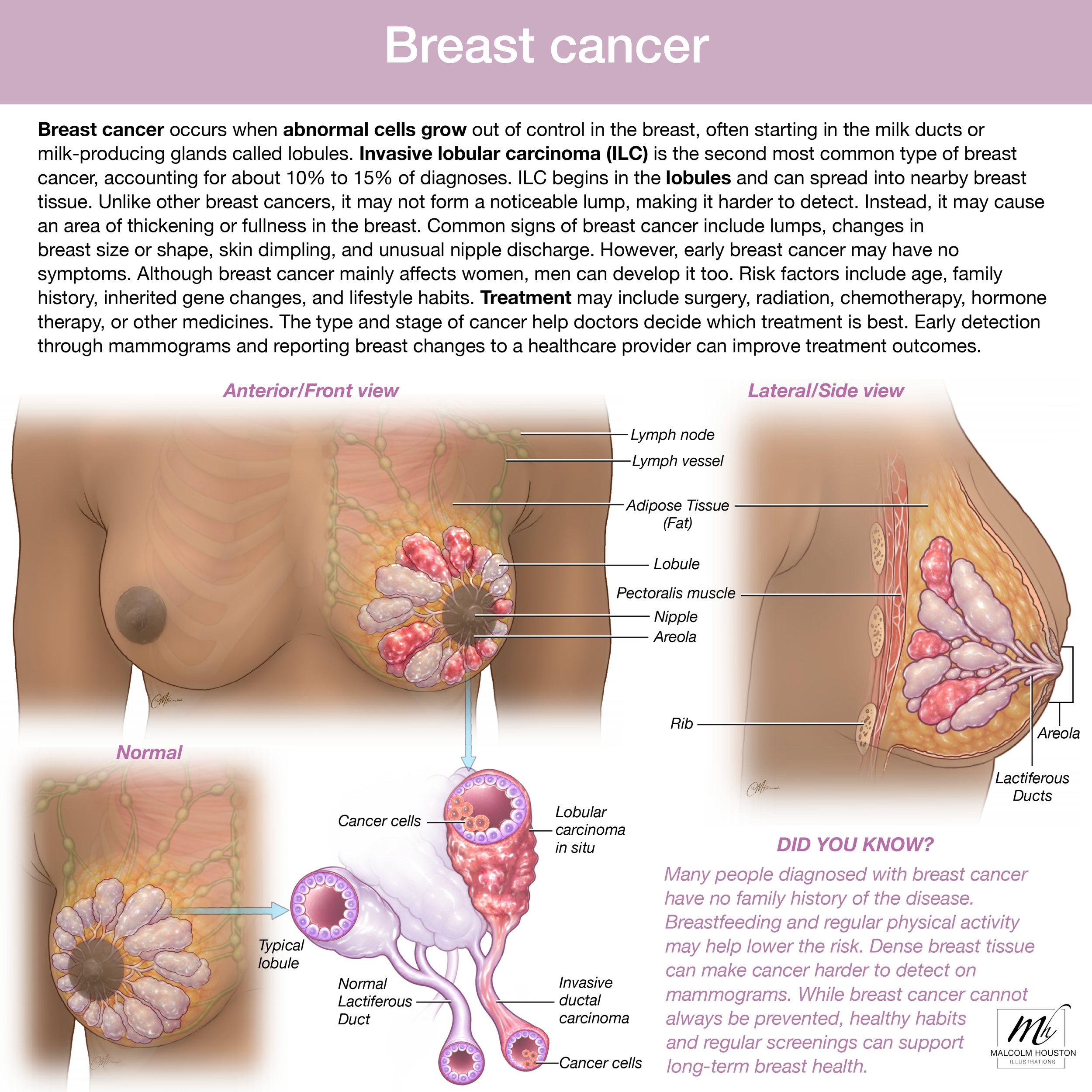 Breast cancer 