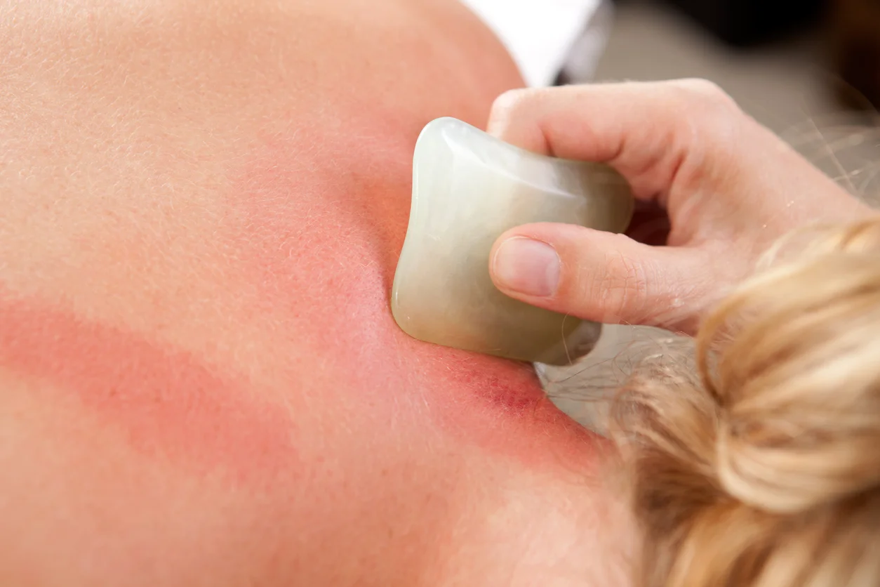Gua Sha: A light scraping on the skin in a small area using a smooth-edged instrument. The scraping motion may create raised redness or bruising. Any bruising usually resolves in 3-7 days. This method treats colds, fever, flu, strains and muscle pai…
