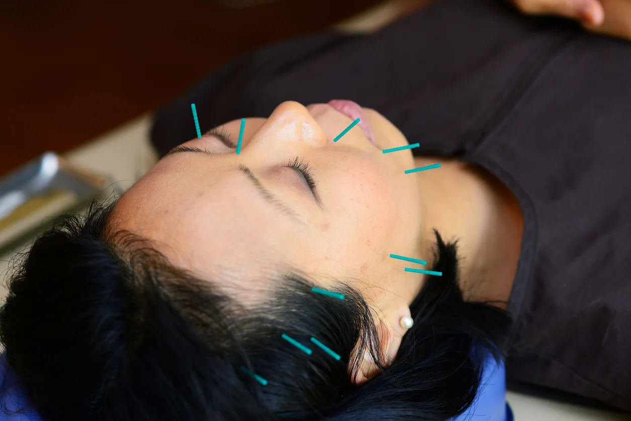 Mei Zen Cosmetic Acupuncture (Facial Rejuvenation): Fine needles are inserted into the dermis layer to stimulate collagen growth.
