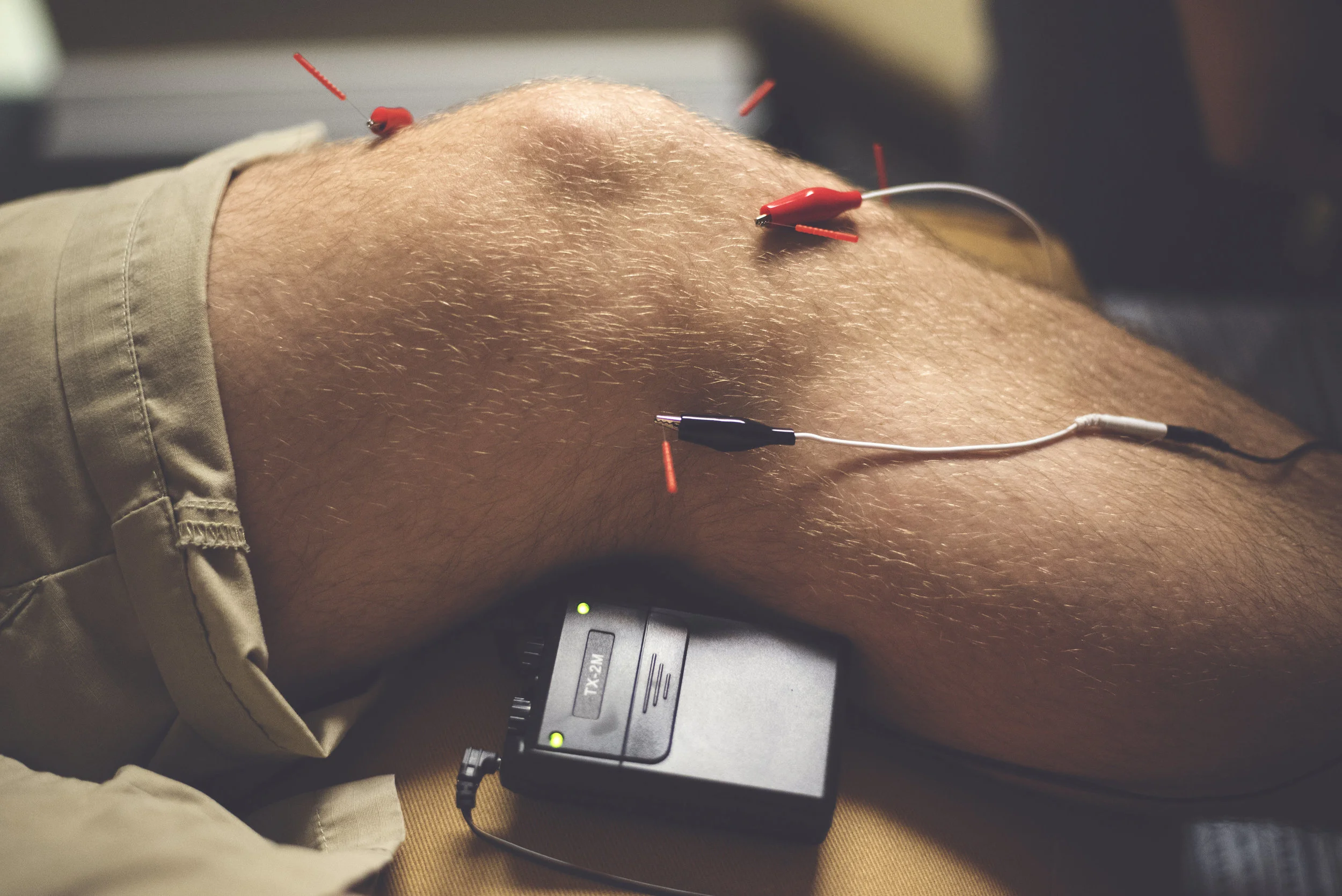 Electro-acupuncture: Is applied to inserted needles to stimulate the acupuncture points. 