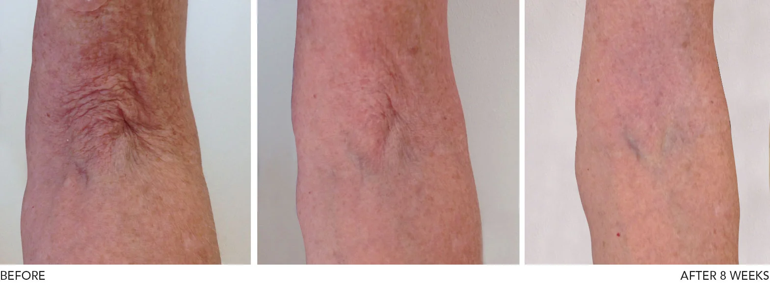profhilo-before-after-arms-2.jpg