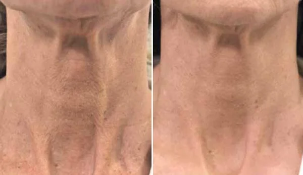profilo-neck-before-and-after.jpg