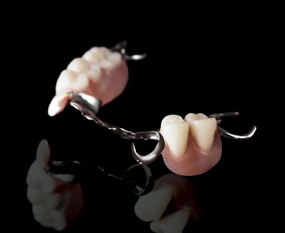 WIRONIUM CAST PARTIAL (RIGID) DENTURE