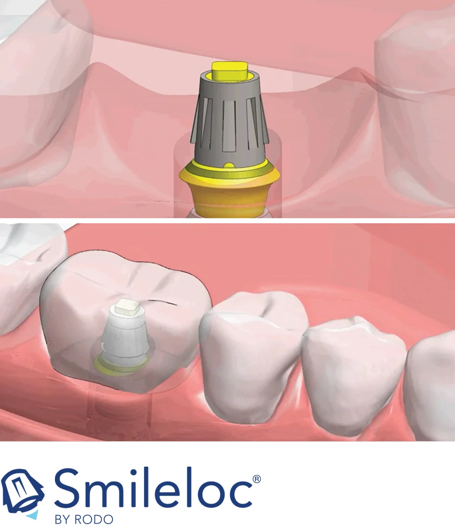 Distributed by MicroDental Laboratories