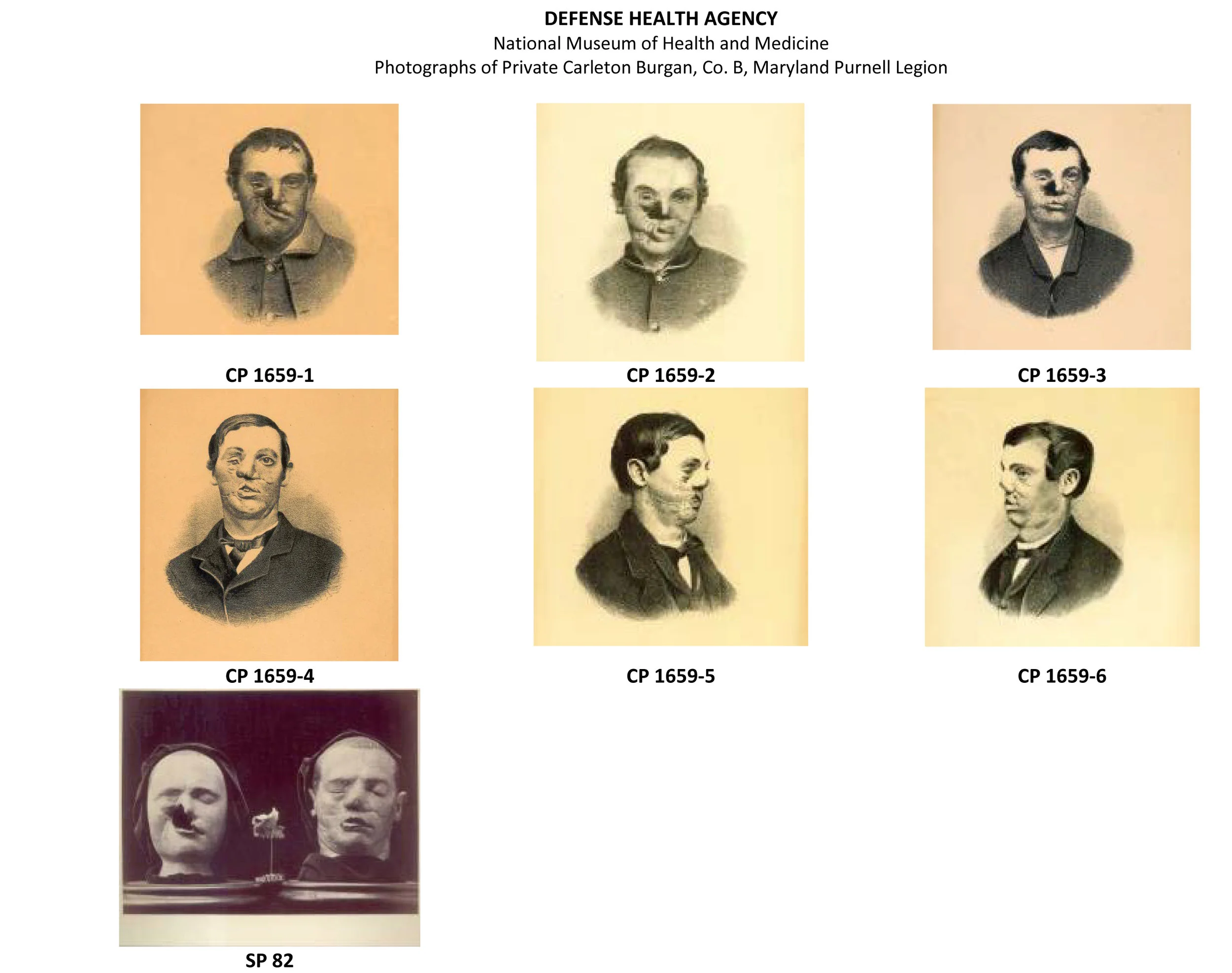 Private Burgan underwent multiple, progressive surgeries to repair damage to his face caused by calomel, a Mercury compound. Though never completely healed, he lived a long life as a family man after the Civil War. 