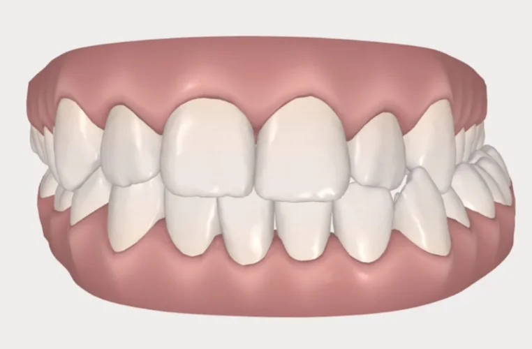 Where my teeth were when I began the treatment. Tray 1 our of 22.