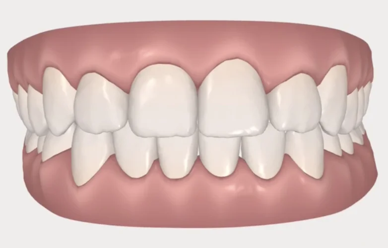 Where my teeth will be after the treatment is completed. 