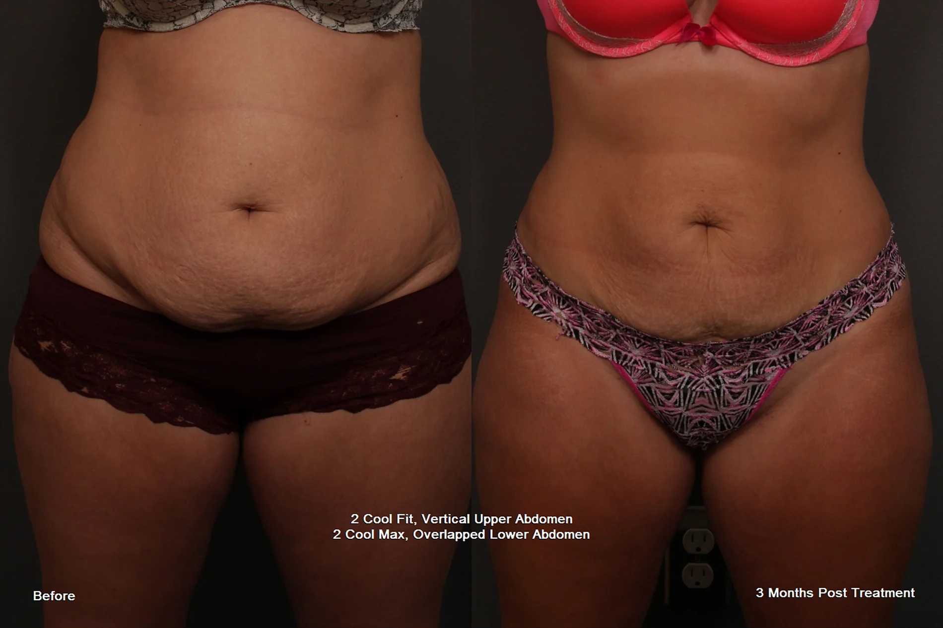 Before and After CoolSculpting Results from Werschler Aesthetics in Spokane, WA