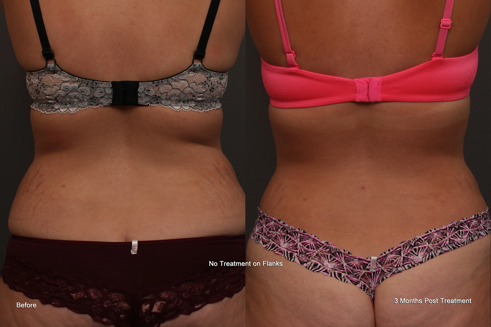 Before and After CoolSculpting Results from Werschler Aesthetics in Spokane, WA
