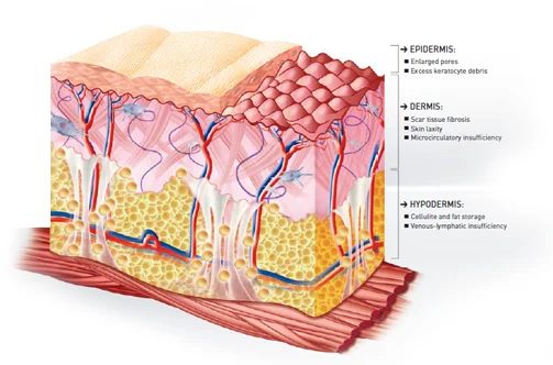 Endoderma Ne Rrenje Endermotherapie — Amara Wellness Centre