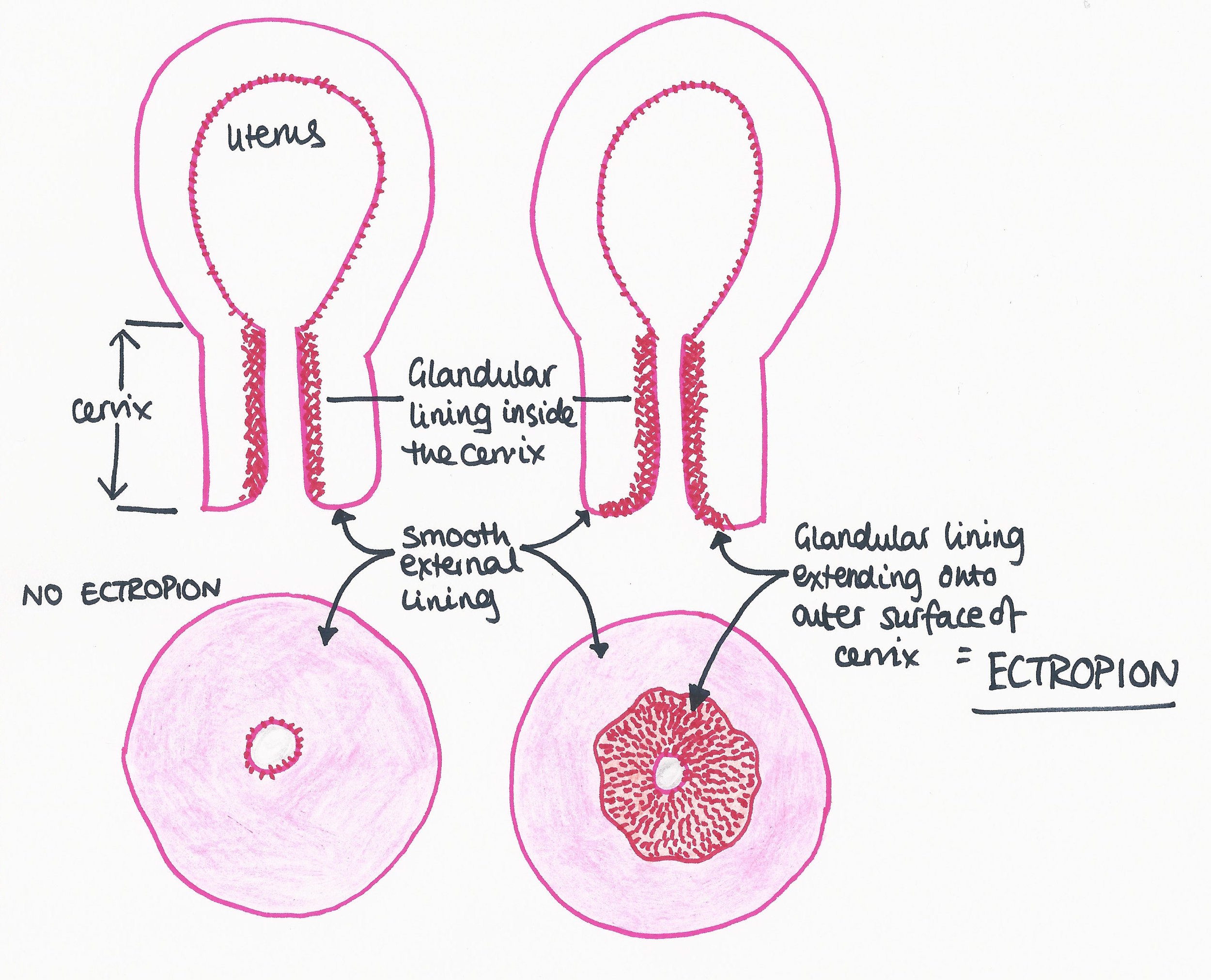Time for some more terrible gynaegeek artistry... The doughnuts at the bottom are the cervix being viewed end on, as it is seen during a speculum examination (aka 'the fanny clamp of death' as my patient called it last week. NB. she agreed afterwards this was a gross exaggeration and I was actually really gentle...:-D)
