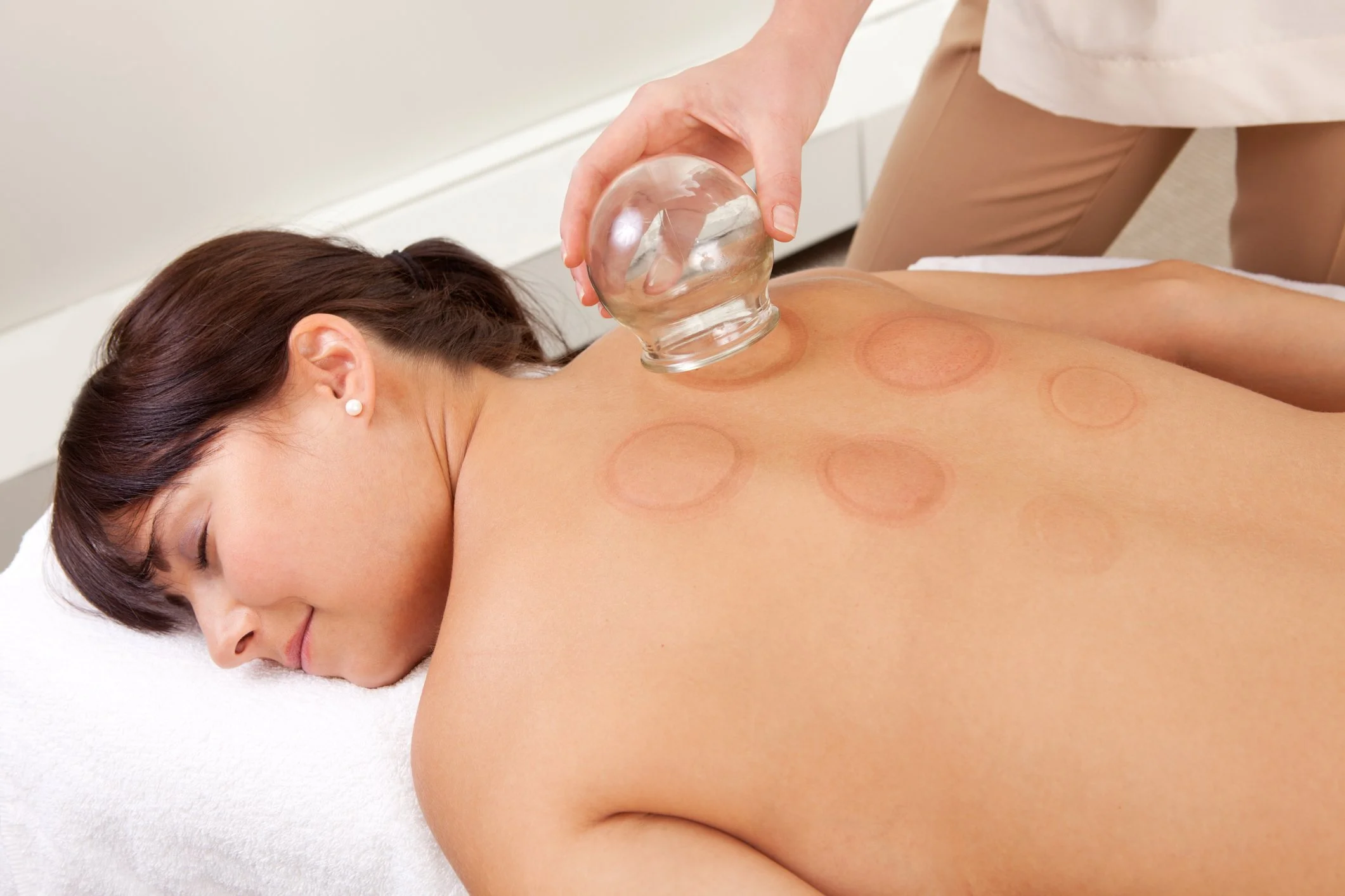 Cupping therapy session for pain relief at Blue Sky Acupuncture in Woodbury NY