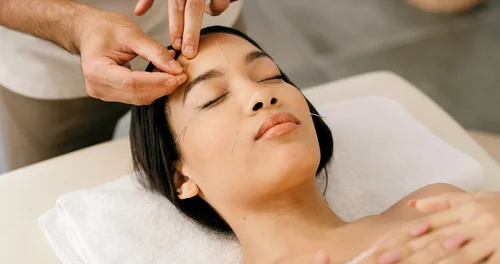 Cosmetic Facial Acupuncture