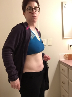 THis is me a couple of hours later. My "before" and "after" shots aren't great because I was so tired at this point - after midnight before i felt like I could finally lay down without being in pain. I can tell my face is more relaxd in this photo - less pain.