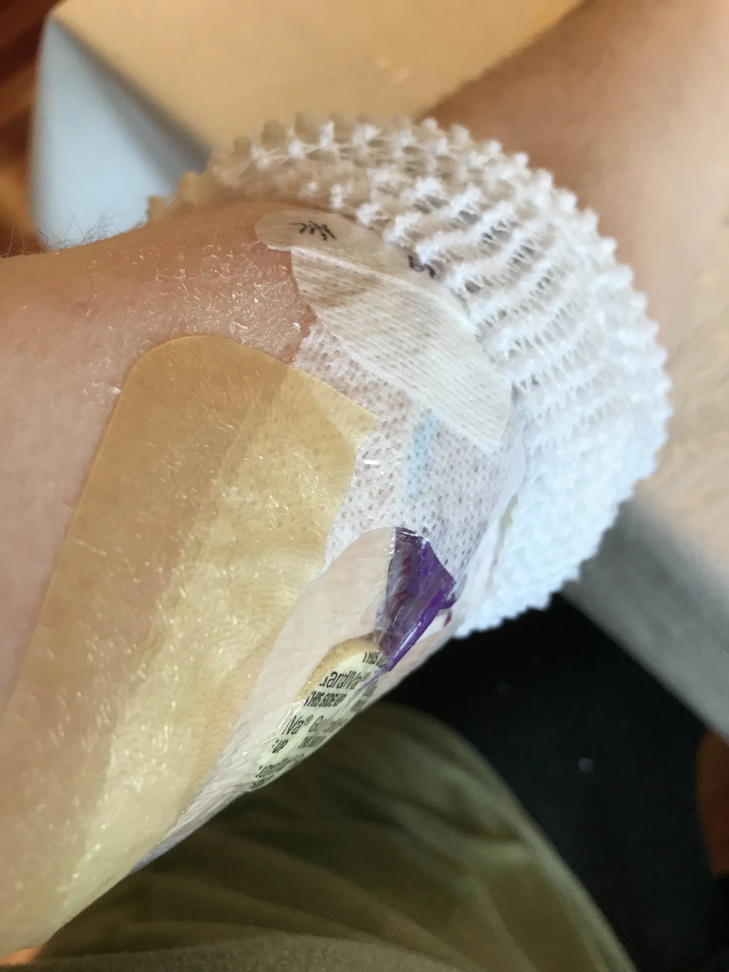 I have to reinforce my bandage now because it keeps opening up right near the “site” which refers to the entry point of the where the needle is threaded in my vein. This line allows me to give myself IV bags at home which is FAR better than having to drive to an infusion center every day!