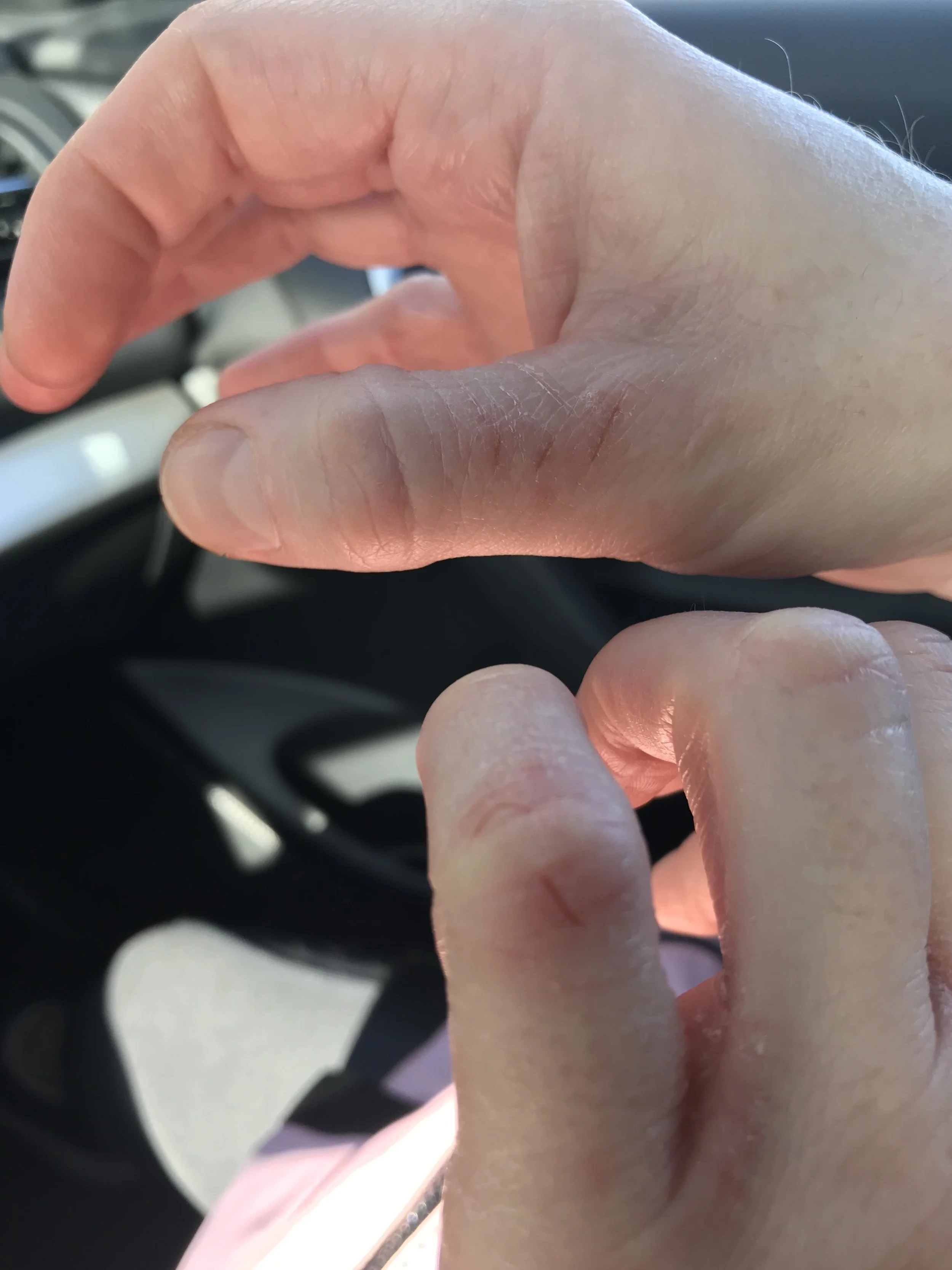 When my hands crack open it is not the same as when an able-bodied person’s hands crack open. They’ll have some sore hands. MINE MEANS MY ORGANS AREN’T GETTING WHAT THEY NEED.
