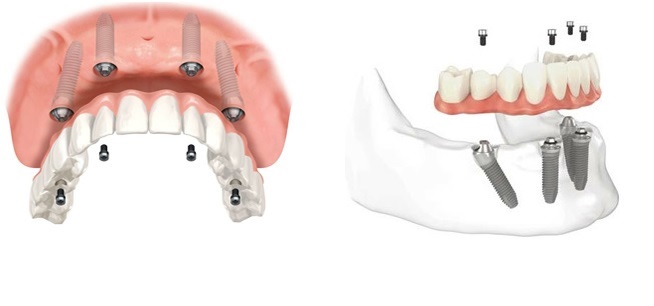 implantes.jpg