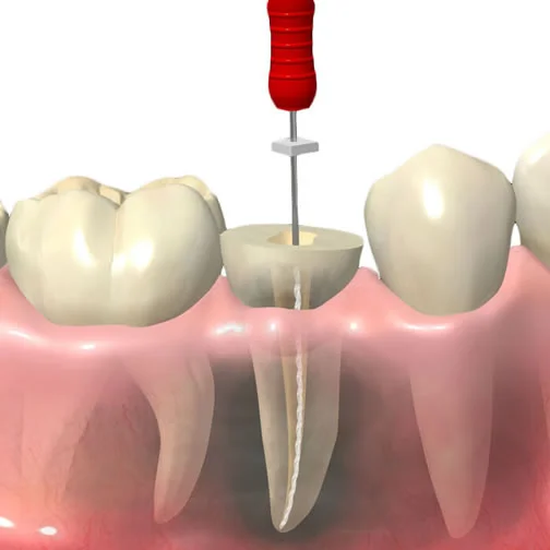endodontia.jpg