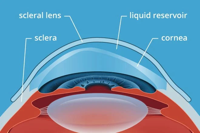 fitting_scleral_lens_image1.jpg
