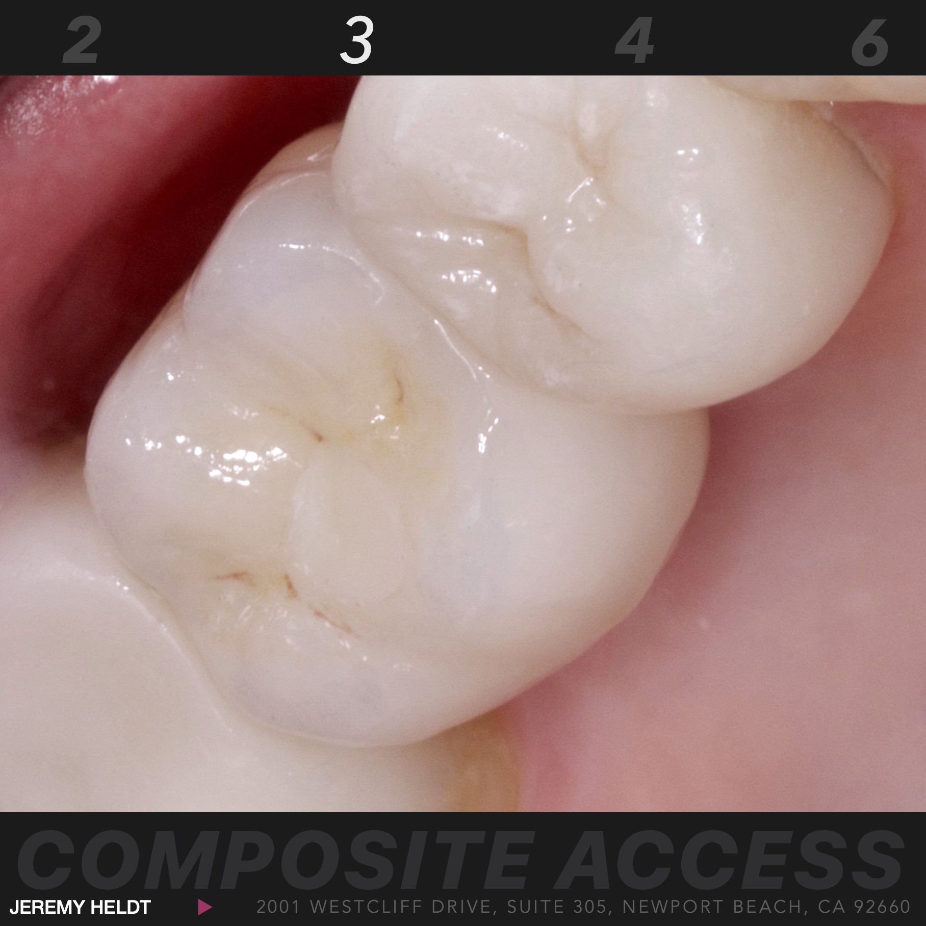 Dental Implant Abutment and Crown Newport Beach