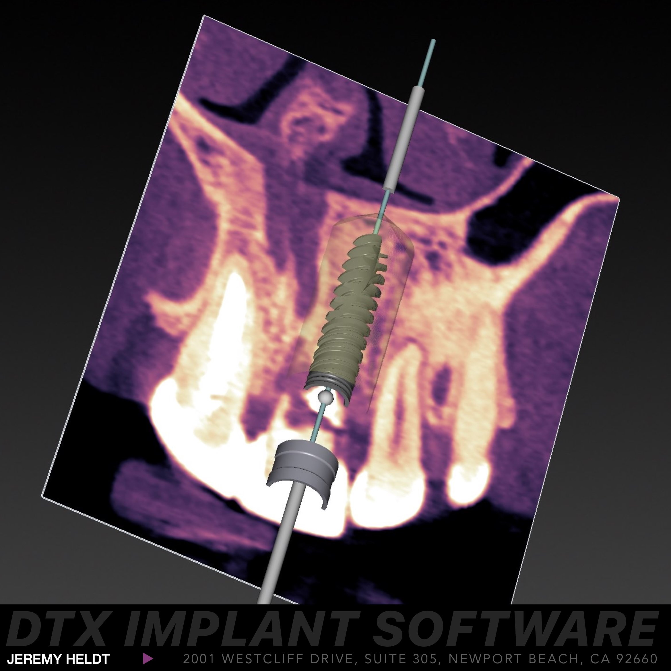 Guided surgery for dental implants