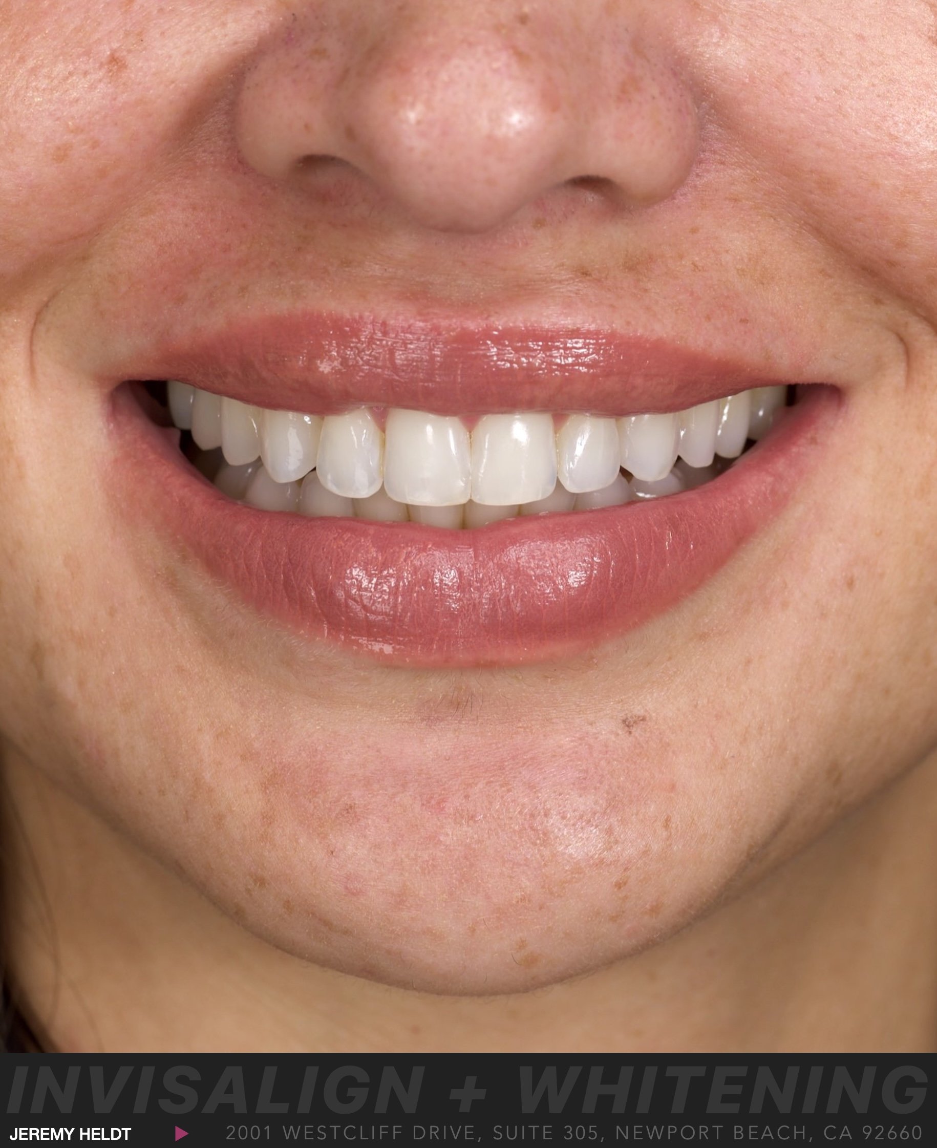 Invisalign Newport Beach by Jeremy Heldt