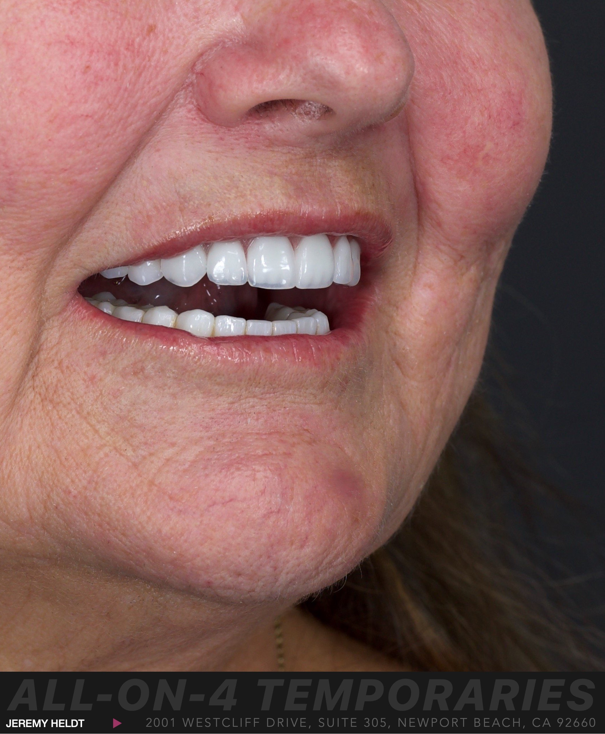 All-on-4 Dental Implants Newport Beach