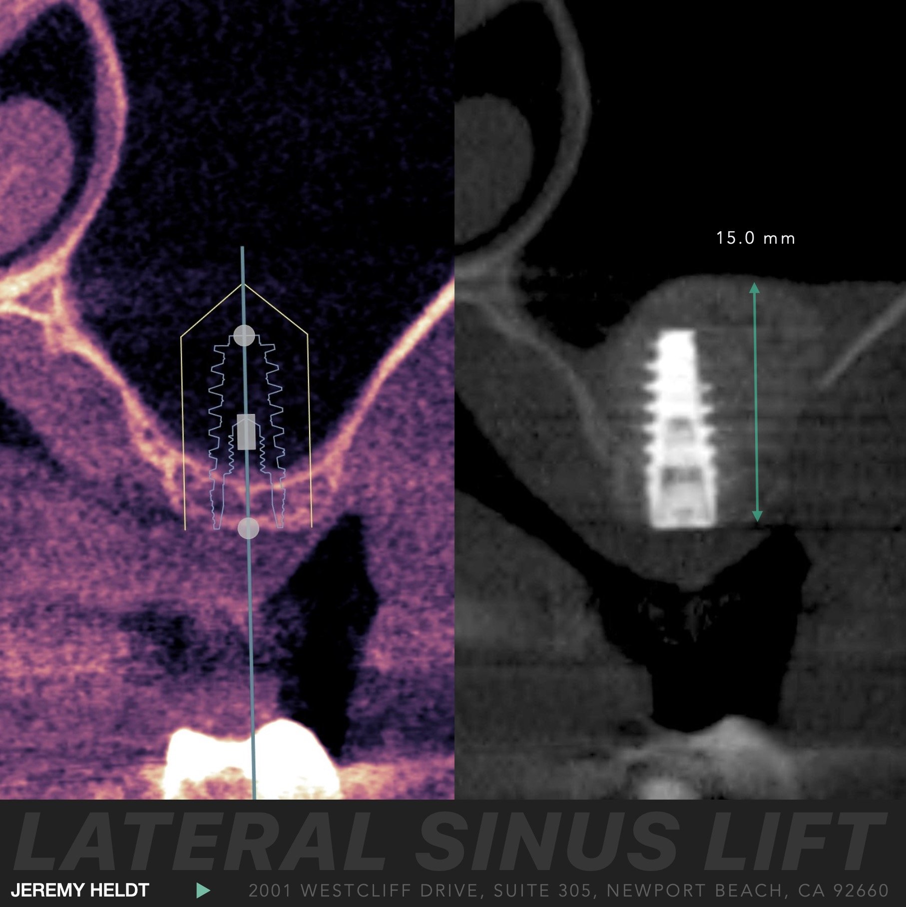 Dental Implants Sinus Lift Abutment and Crown Newport Beach