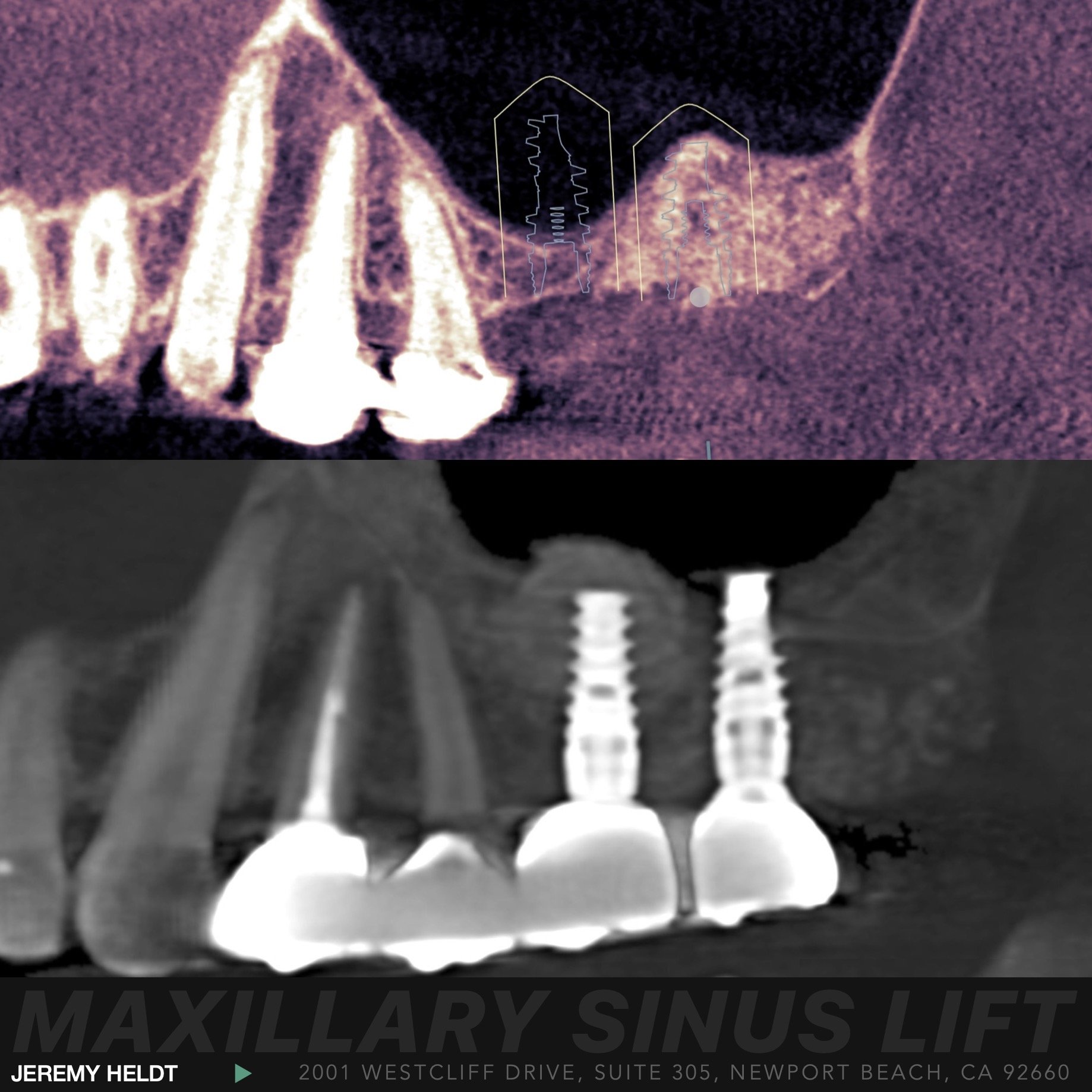 Dental Implants Sinus Lift Abutment and Crown Newport Beach