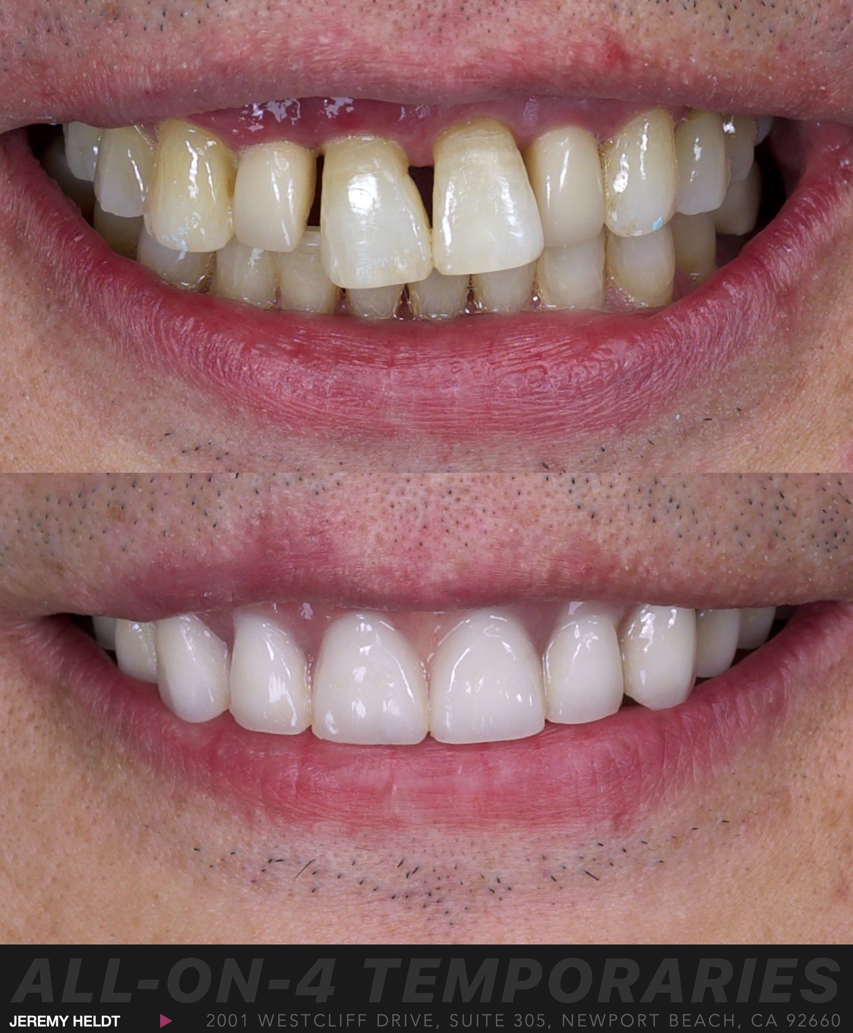 All-on-4 Dental Implants Newport Beach.  Implant-Supported Bridge.  All-on-X by Jeremy Heldt, DDS.