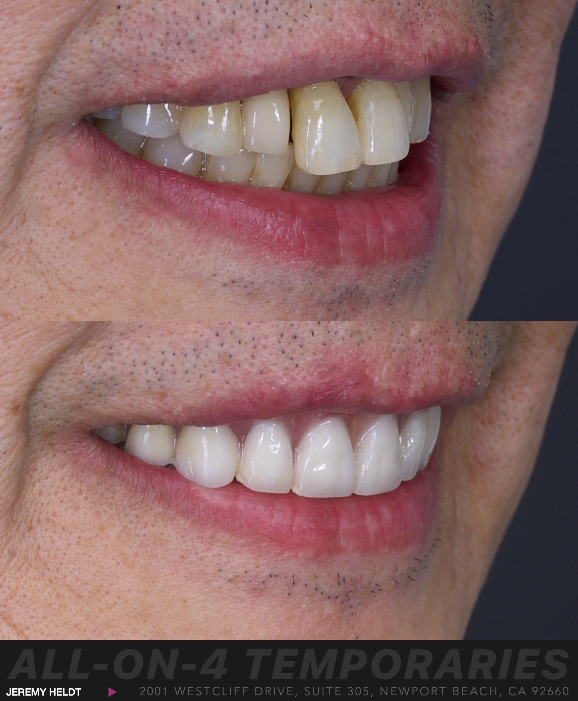 All-on-4 Dental Implants Newport Beach.  Implant-Supported Bridge.  All-on-X by Jeremy Heldt, DDS.