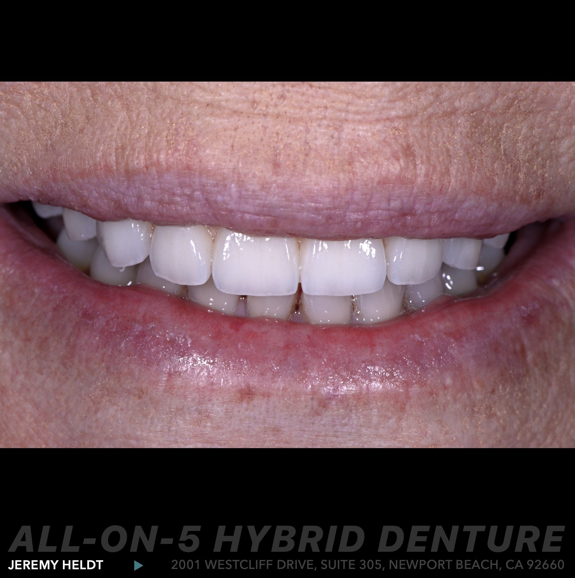 All-on-4 Hybrid Denture Newport Beach by Jeremy Heldt, DDS.  Implant Dentist.  Cosmetic Dentist.