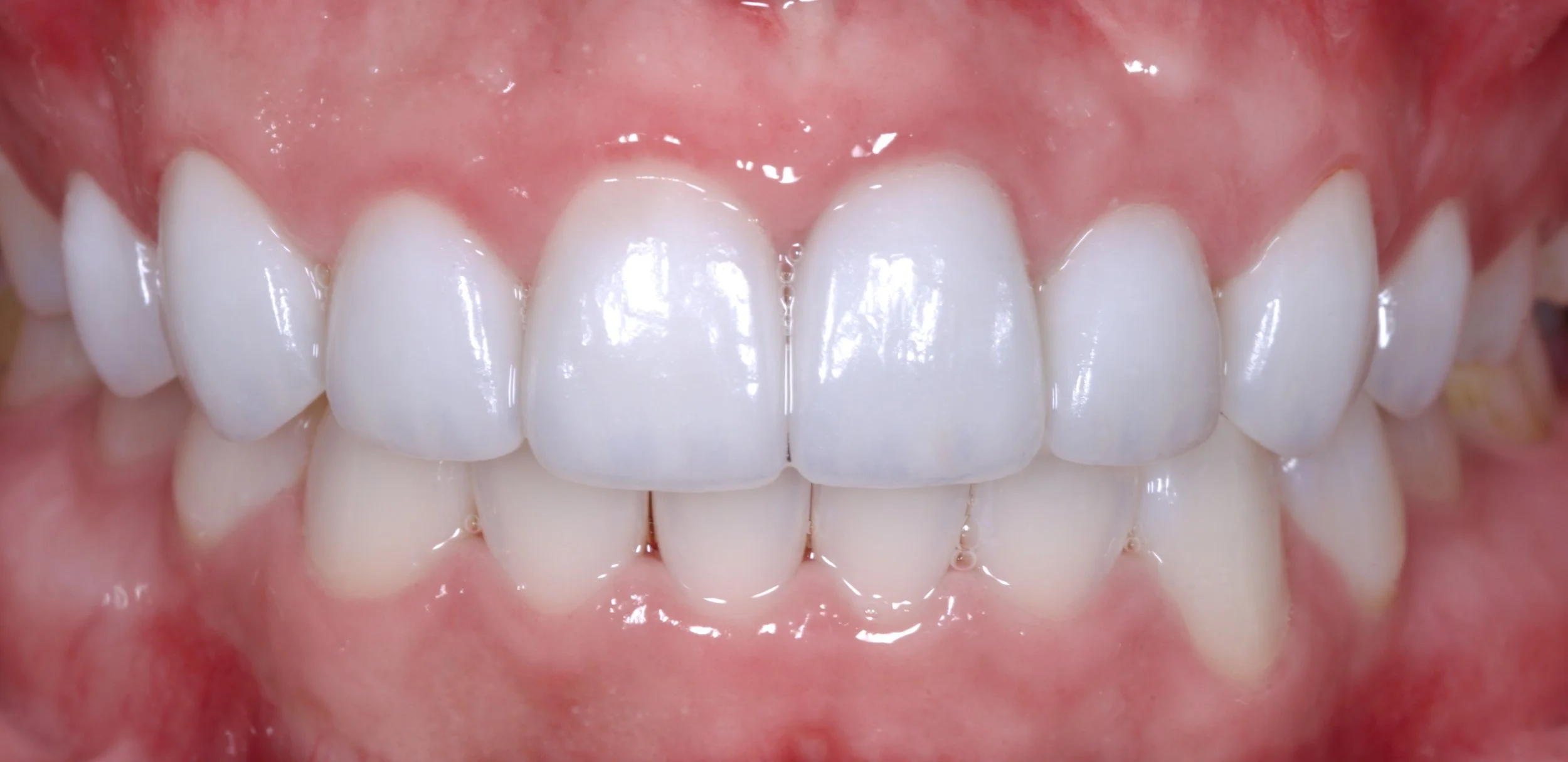 Veneers Newport Beach Dentist Veneers, Dental Implants, Allon4