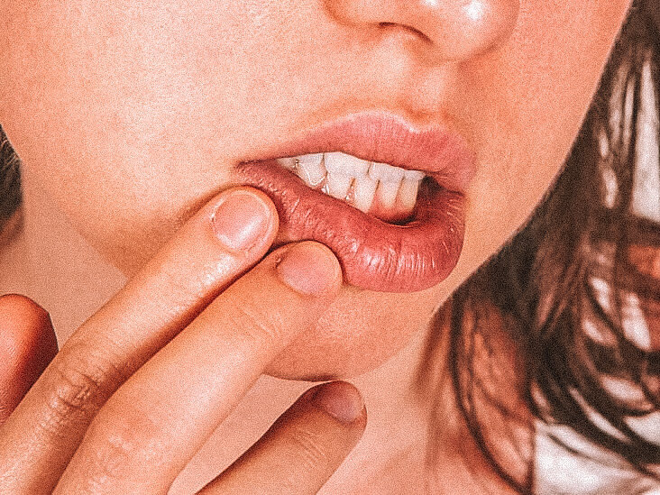 Does Ayahuasca Cure Herpes Mariah Laine Moyle