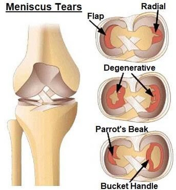 Torn knee meniscus? Try physical therapy first, surgery later.

An estimated 460,000 patients in the United States get surgery each year to fix knee cartilage that tears, often because of osteoarthritis. The tear is painful, and many patients fear th