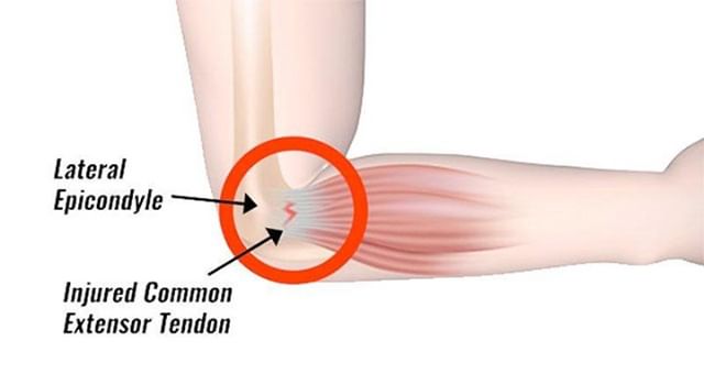 TENNIS ELBOW could be diagnosed when elbow pain develops gradually as a result of repetitive or forceful use of the wrist, hand, and elbow. 
Symptoms may also include: Pain that radiates into your forearm and wrist and occurs when lifting objects, op