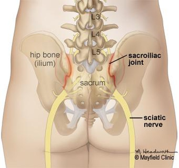 Sacroiliac (SI) Joint Pain:
The signs and symptoms of SI pain start in the lower back and buttock, and may radiate to the lower hip, groin or upper thigh. While the pain is usually one sided, it can occur on both sides. Patients may also experience n