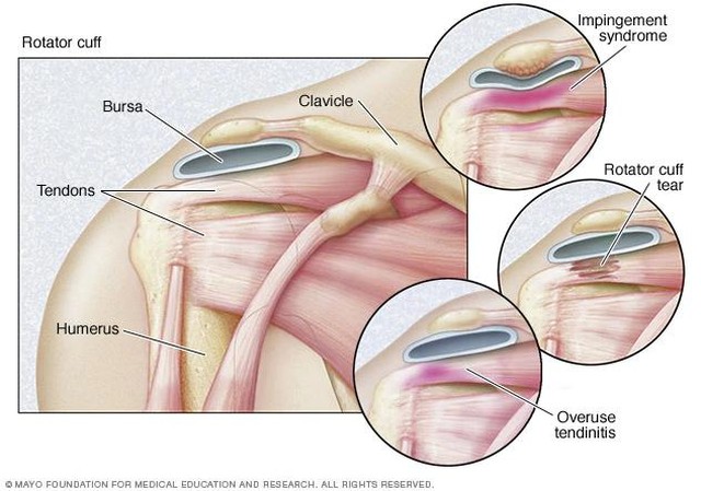 SHOULDER PAIN: Rotator cuff disease may be the result of either a substantial injury to the shoulder or to progressive degeneration or wear and tear of the tendon tissue. Repetitive overhead activity or heavy lifting over a prolonged period of time m