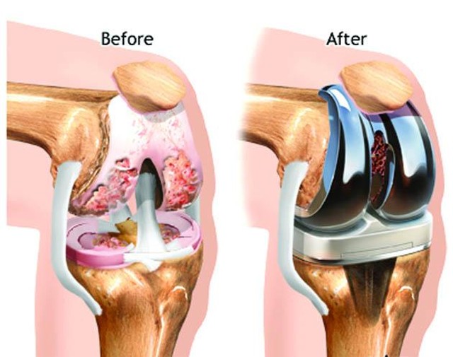 TOTAL KNEE REPLACEMENT:
A surgical procedure to resurface a knee damaged by arthritis. Metal and plastic parts are used to cap the ends of the bones that form the knee joint, along with the kneecap. This surgery is often the choice for someone who ha